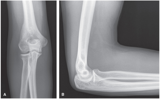 FIGURE 9 A AP elbow B Lateral elbowTrauma Good to assess for otherwise - photo 9