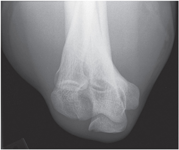 FIGURE 11 Cubital tunnel viewHUMERUS To assess for trauma infection mass - photo 11