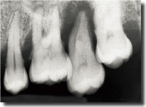 Periodontal disease is an inflammatory disease caused by a bacterial infection - photo 3