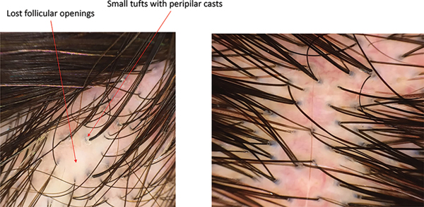 FIGURE 11 Two patients with thick hair density A is suspicious for scarring - photo 2