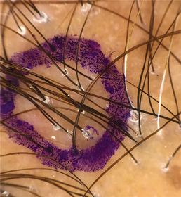 FIGURE 12 Dermoscopy helps to select the optimal site for the biopsy as in - photo 3