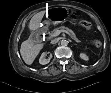 Image 5 Image 6 Gallstone ileus is a rare complication of gallstone - photo 5