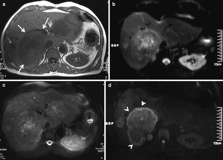 Fig 11 Patient with hepatocellular carcinoma Conventional T1 a and - photo 1