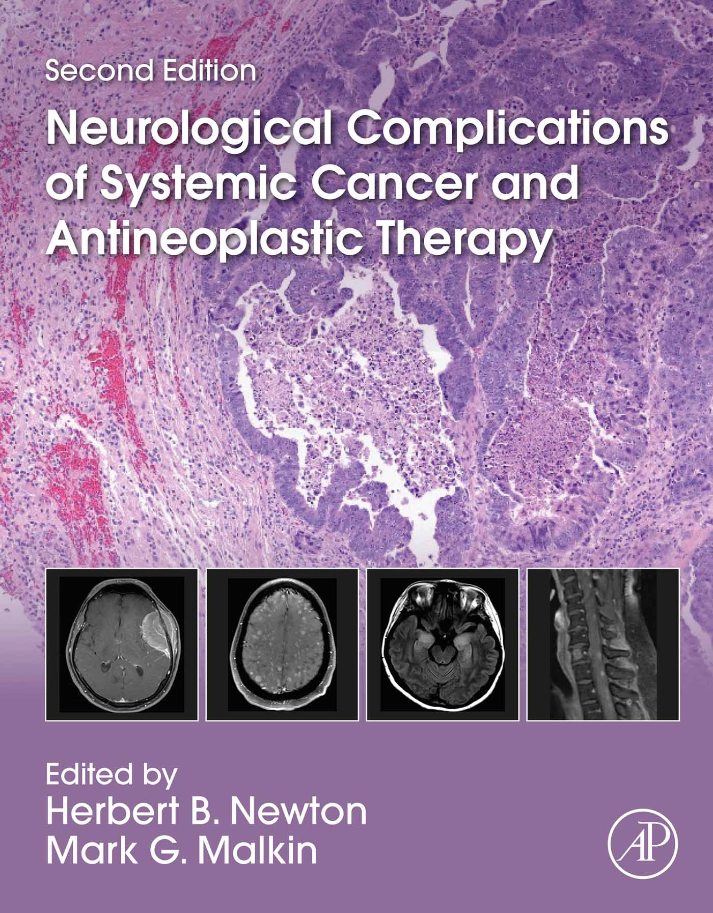 Neurological Complications of Systemic Cancer and Antineoplastic Therapy Second - photo 1