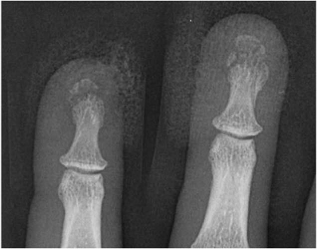 Case 1-01 Phalangeal tuft fractures PA radiograph of the index and middle - photo 1