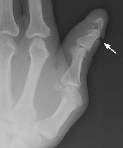 Case 1-02 Phalangeal tuft fracture with nail bed injury Multiple radiographs - photo 2