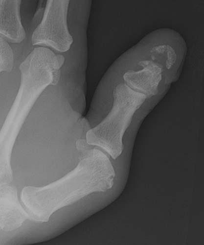 Case 1-02 Phalangeal tuft fracture with nail bed injury Multiple radiographs - photo 3