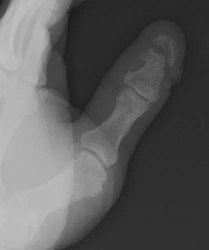 Case 1-02 Phalangeal tuft fracture with nail bed injury Multiple radiographs - photo 4