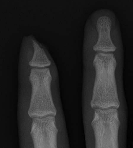 Case 1-03 Fingertip amputation PA radiograph of the index and middle fingers - photo 5