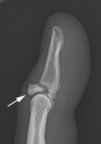 Case 1-04 Mallet finger Lateral radiograph of a finger centered over the DIP - photo 6