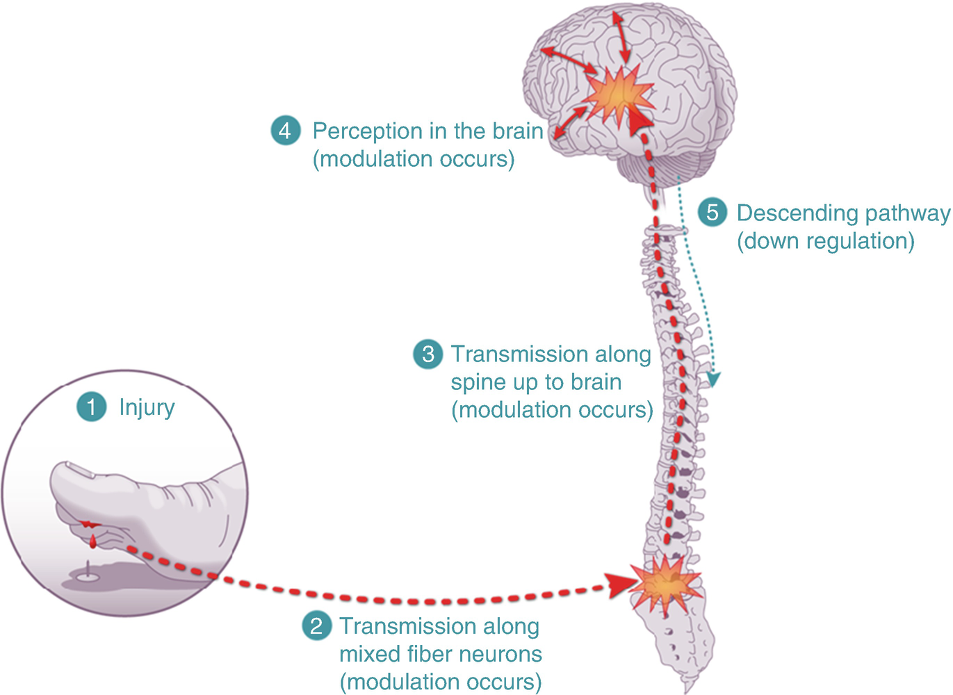 A representation of Neuromechanisms of pain The process involves injury - photo 3