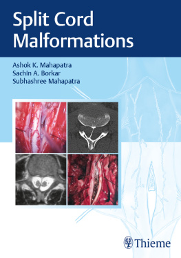 Ashok K. Mahapatra Split Cord Malformations