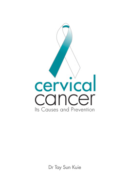 Dr. Tay Sun Kuie - Cervical Cancer