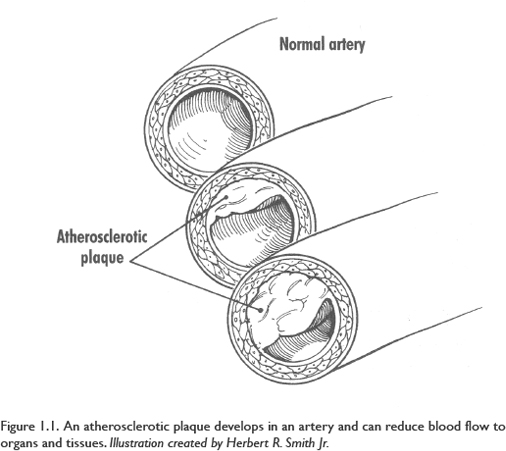 Understanding how coronary heart disease CHD and atherosclerosis develop is - photo 4