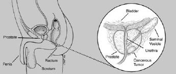 The prostate starts to develop before birth and continues to grow until a man - photo 2