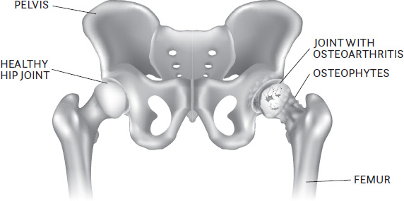 FIGURE 11 Hip joint osteoarthritis a healthy hip joint compared to a joint - photo 2