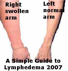 Lymphedema of the upper arm is very commonafter a mastectomy for breast cancer - photo 1