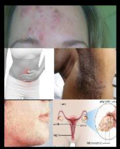 Irregular or absence of menstrual periods Obesity or weight gain Acne - photo 3