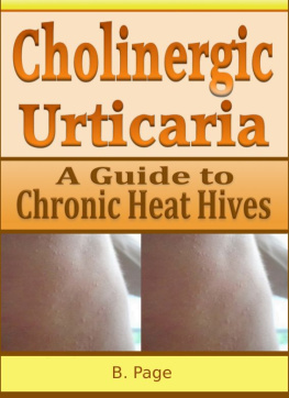 B Page Cholinergic Urticaria: A Guide to Chronic Heat Hives