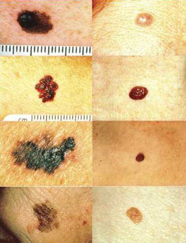 Pictures in the left column are melanomas with worrisome characteristics - photo 5