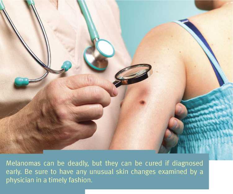 Melanomas may resemble a simple mole which is a benign or harmless - photo 4