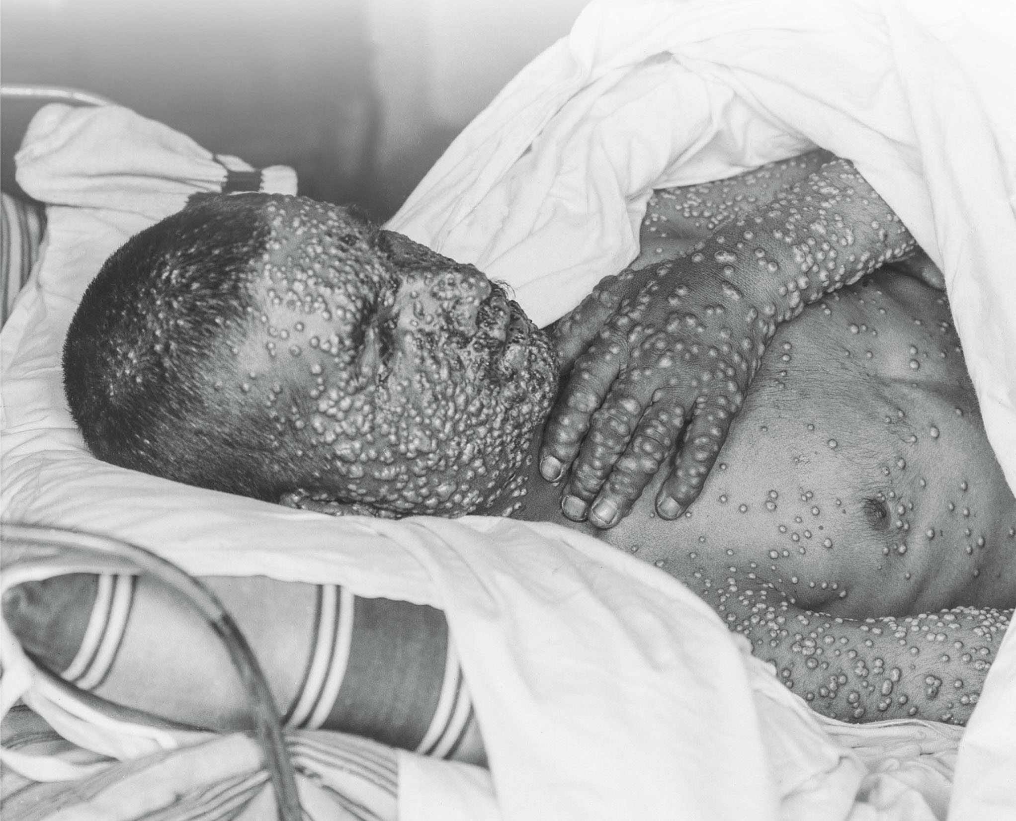 In all forms of smallpox blisters formed on an infected persons body WHAT WAS - photo 4