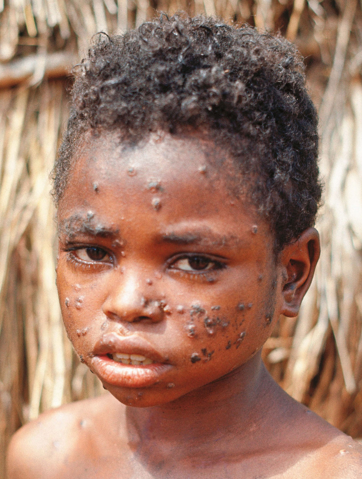 Smallpox often left scars on a persons skin A viruses caused smallpox The - photo 5