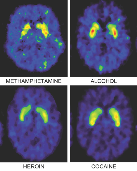 Using drugs and alcohol repeatedly over time alters brain chemistry and - photo 6