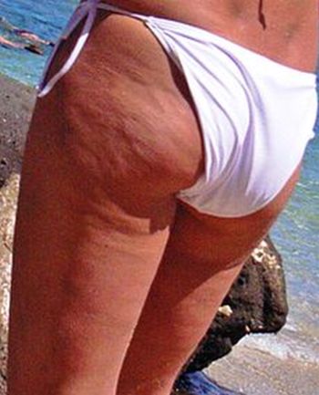 Appearance of Cellulite If youre seeing bumps on your behindyoure in good - photo 4