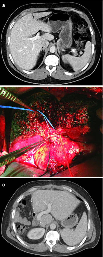 Fig 12 Right lobe living donor liver transplant a Preoperative donor - photo 2