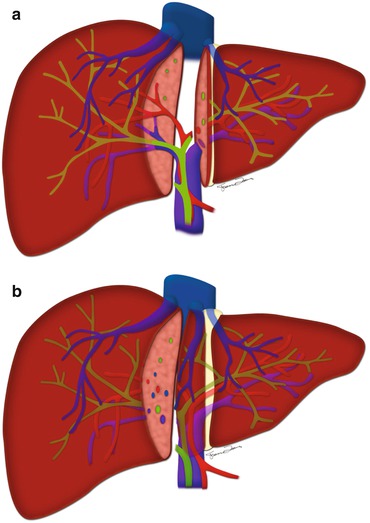 Fig 13 a The left lateral segmentectomy LDLT plane runs to the left of - photo 3