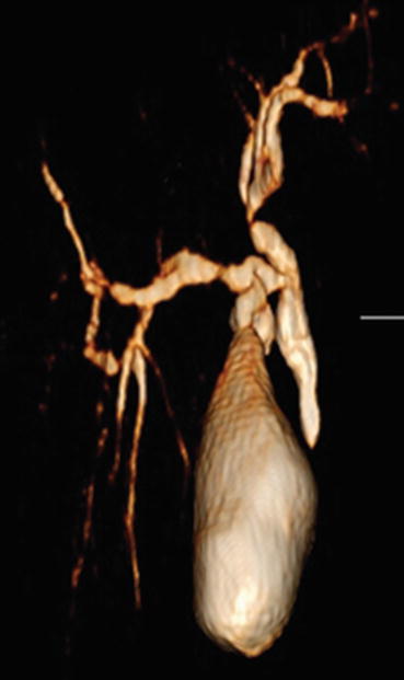 Fig 14 3D reformatted image of a CT cholangiogram showing the common bile - photo 4