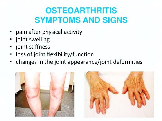 Risk Factors Almost anyone can get osteoarthritis but its most likely if - photo 3