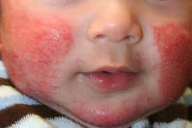 Contact Dermatitis This is a type of eczema that occurs when your skin comes - photo 3