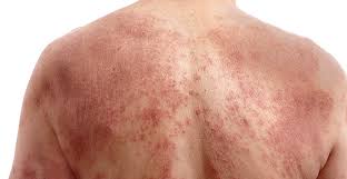 Contact Dermatitis This is a type of eczema that occurs when your skin comes - photo 4