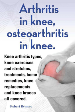 Robert Rymore Arthritis in knee, osteoarthritis in knee. Knee arthritis exercises and stretches, treatments, home remedies, knee replacements and knee braces all covered.