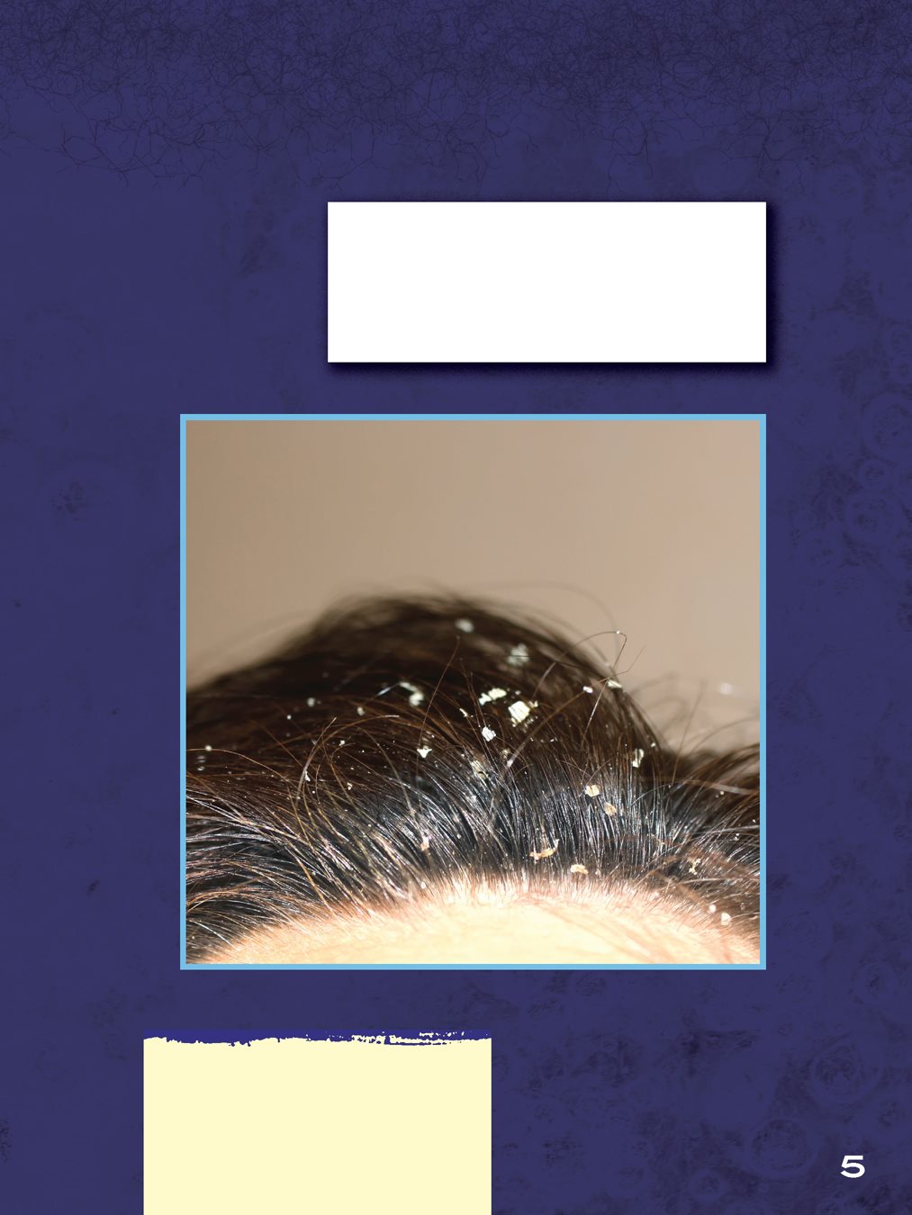 Dandruff is skin that flakes off from your scalp the skin on your head - photo 7