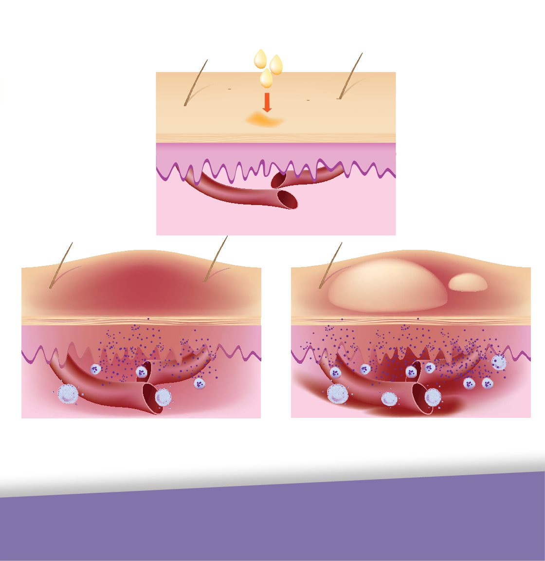 Urushiol oil Mild Severe Urushiol can cause your cells to release a - photo 13