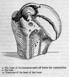 Musket-ball wound of the shoulder a ball lodged in the head of the humerus - photo 14