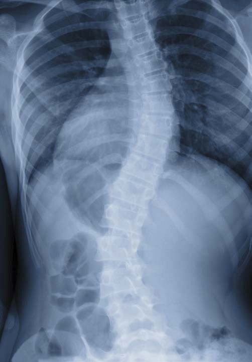 Scoliosis is a condition that curves the spine Ma had Scoliosis is when the - photo 7