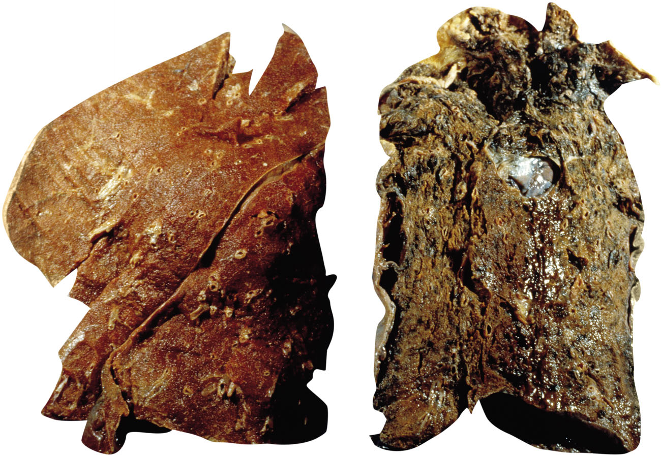 normal lungleft smokers lungright In the 1700s most doctors believed that - photo 10