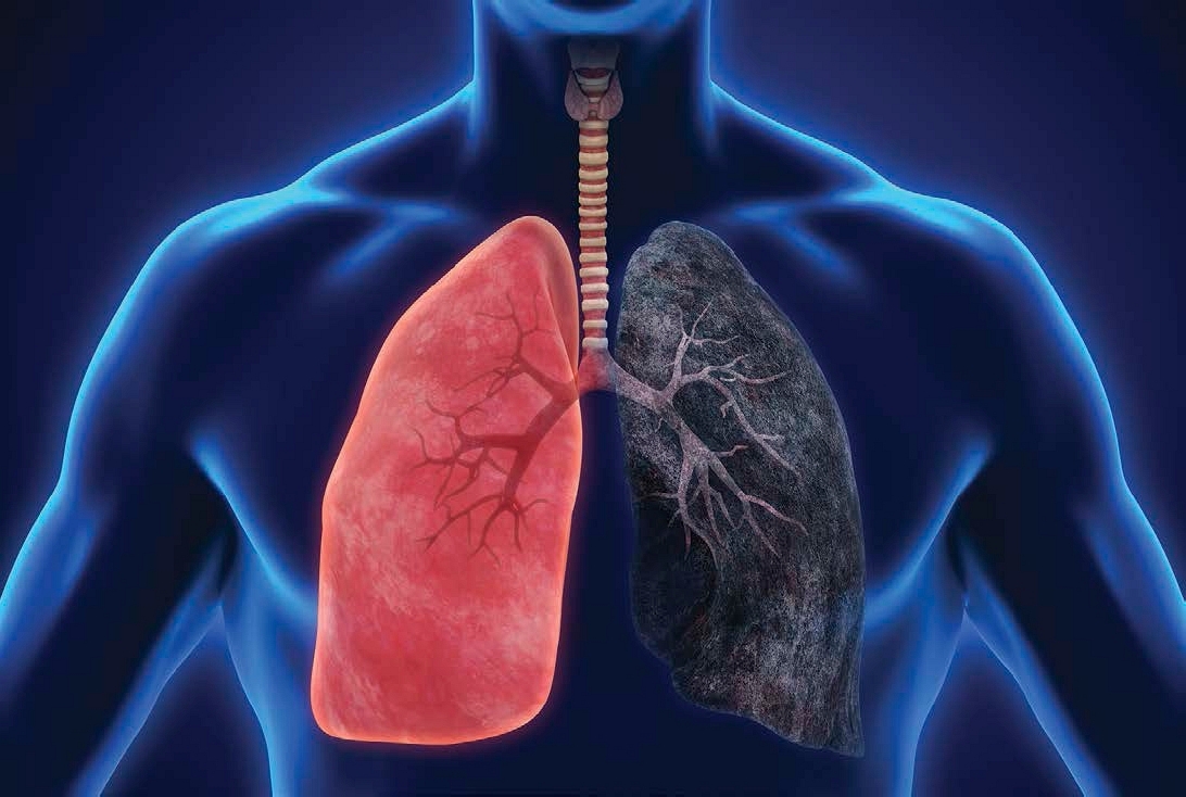 This illustration shows a healthy lung on the left and a diseased lung on the - photo 4