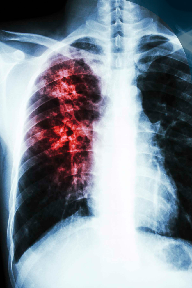 A chest X-ray shows interstitial infiltration at the right lung due to a type - photo 3