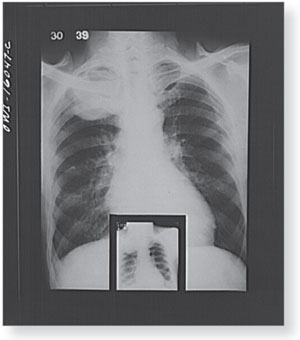 Lungs afflicted with tuberculosis Library of Congress LC-USW3-016047-C - photo 2