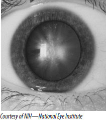 A cortical cataract forms as a wedge on the lens and gradually extends spokes - photo 4