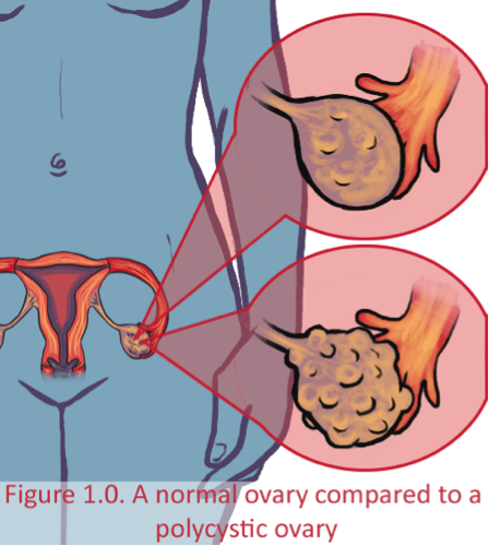 Polycystic ovaries are one of the hallmarksof PCOS and are what often shows up - photo 1