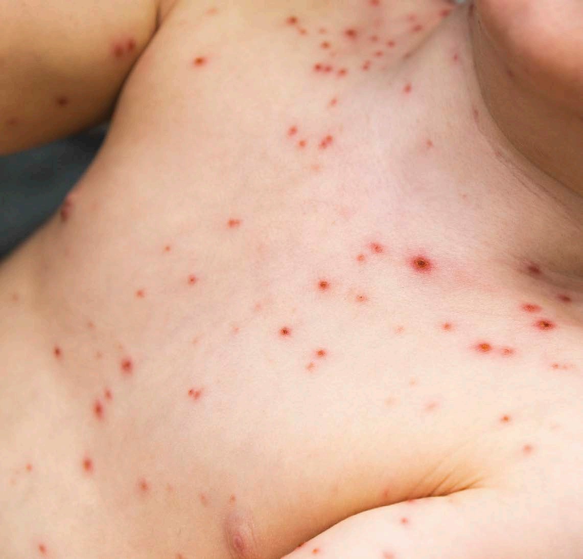 CHICKENPOX RASH WHAT ARE VACCINES Vaccines allow the body to have a trial run - photo 5