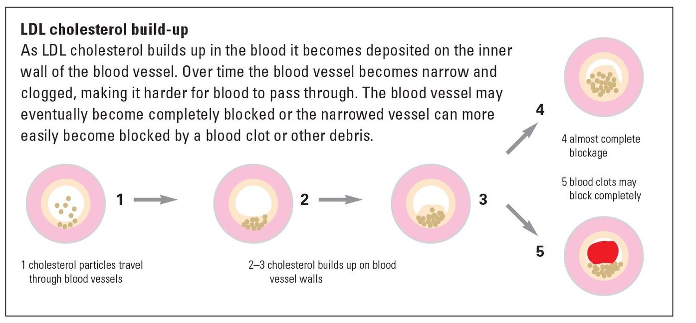 These diseases of the heart and blood vessels caused by atherosclerosis are - photo 4