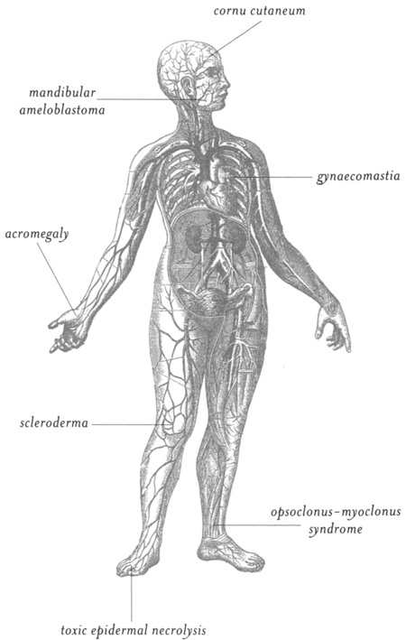 In which an overachieving immune system causes excess growth in parts of your - photo 1