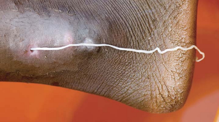 A guinea worm crawls out of a patients foot in Ghana Guinea worms were once - photo 2